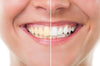 Teeth Whitening Tips To Try At-Home | NewSmile® Aligners