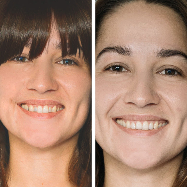 Braces vs. Clear Aligners | Which is better? - NewSmile